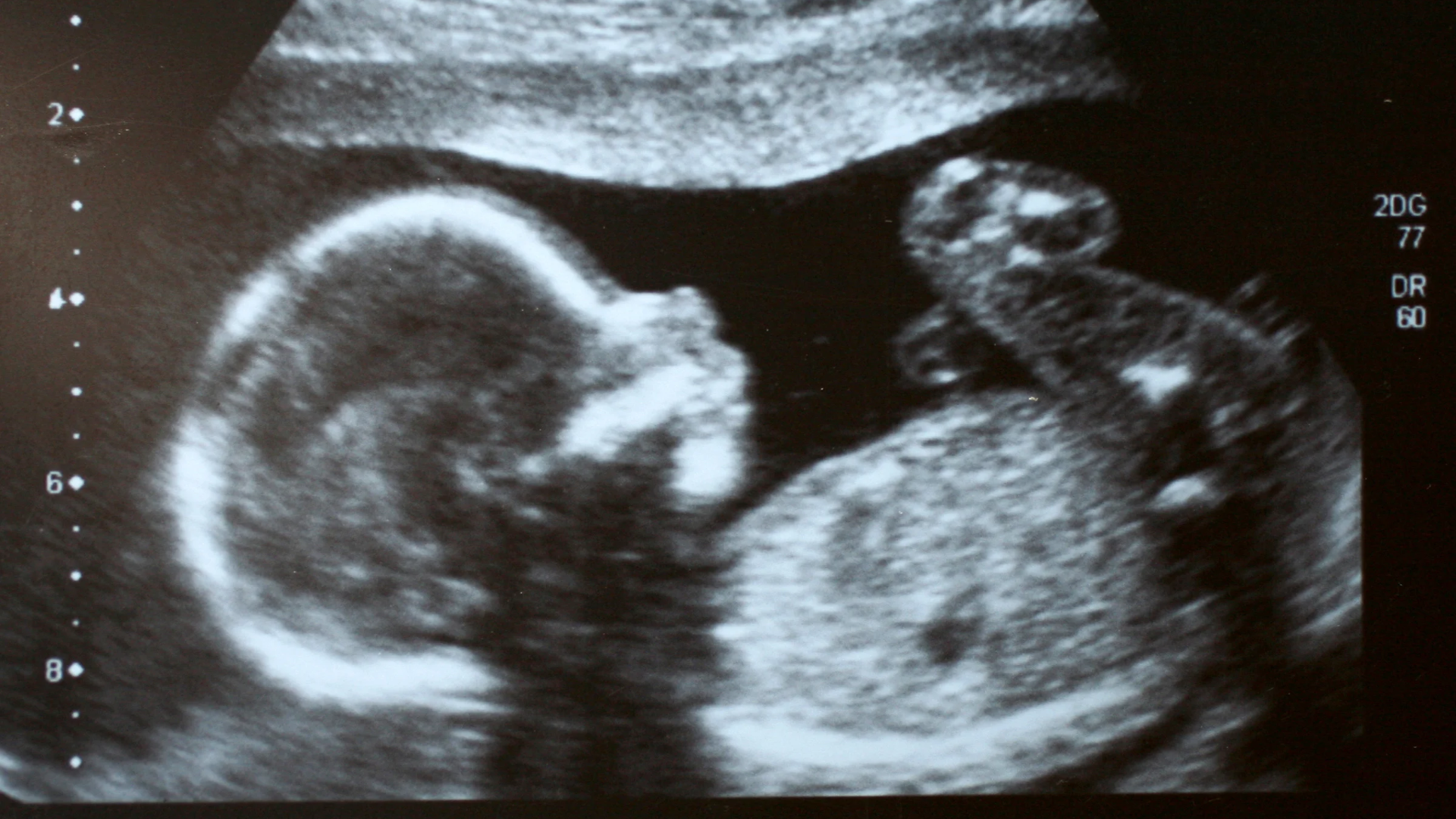 Ovēa OB scan guide hero photo