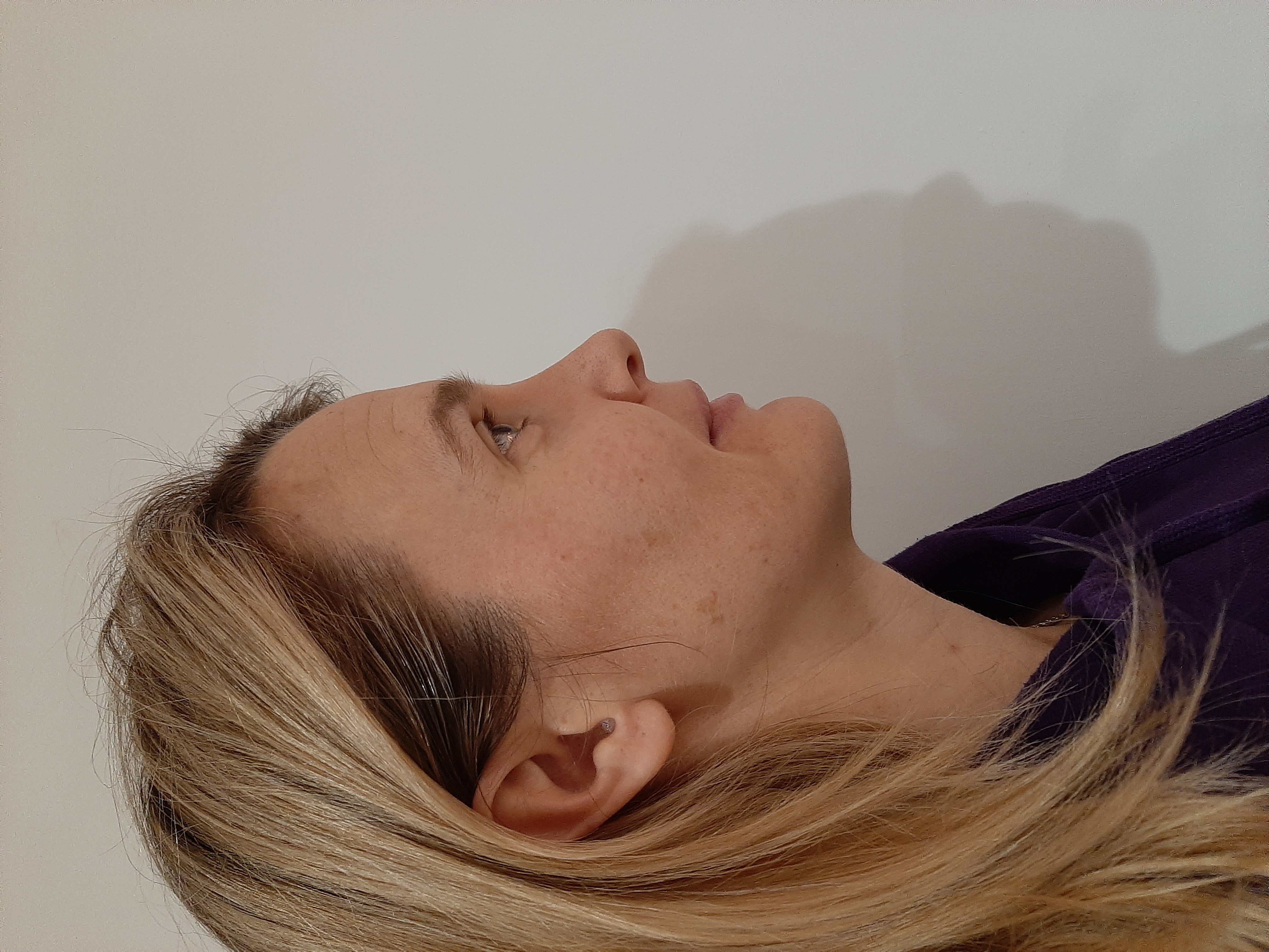 Liz, before treatment