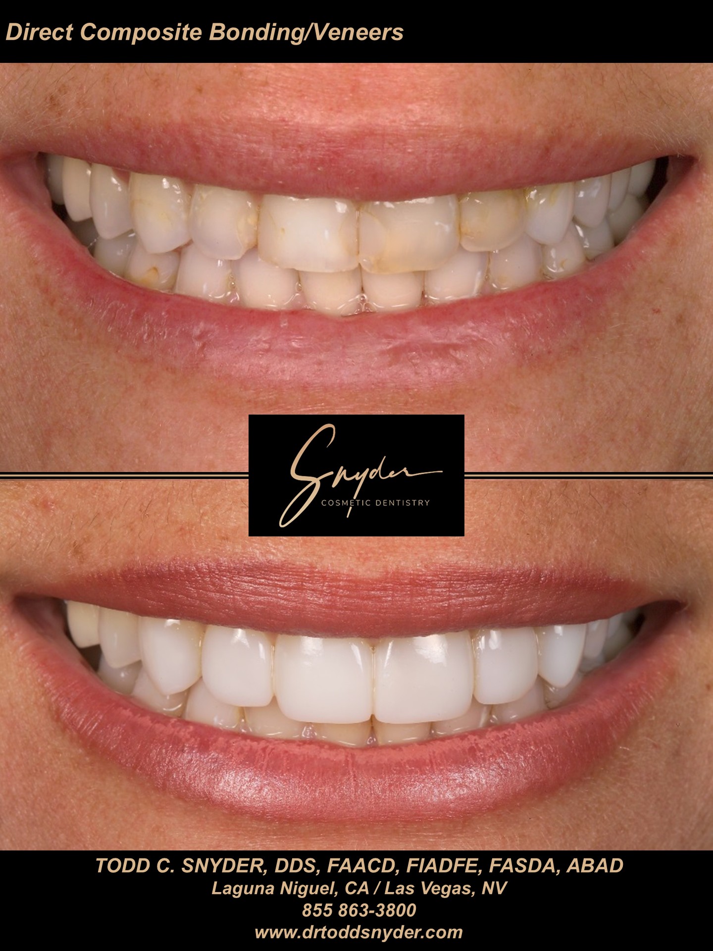 Direct composite bonding and veneers, before and after