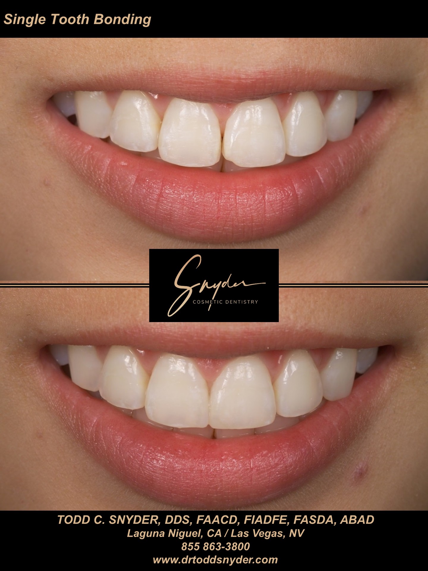 Single tooth bonding, before and after