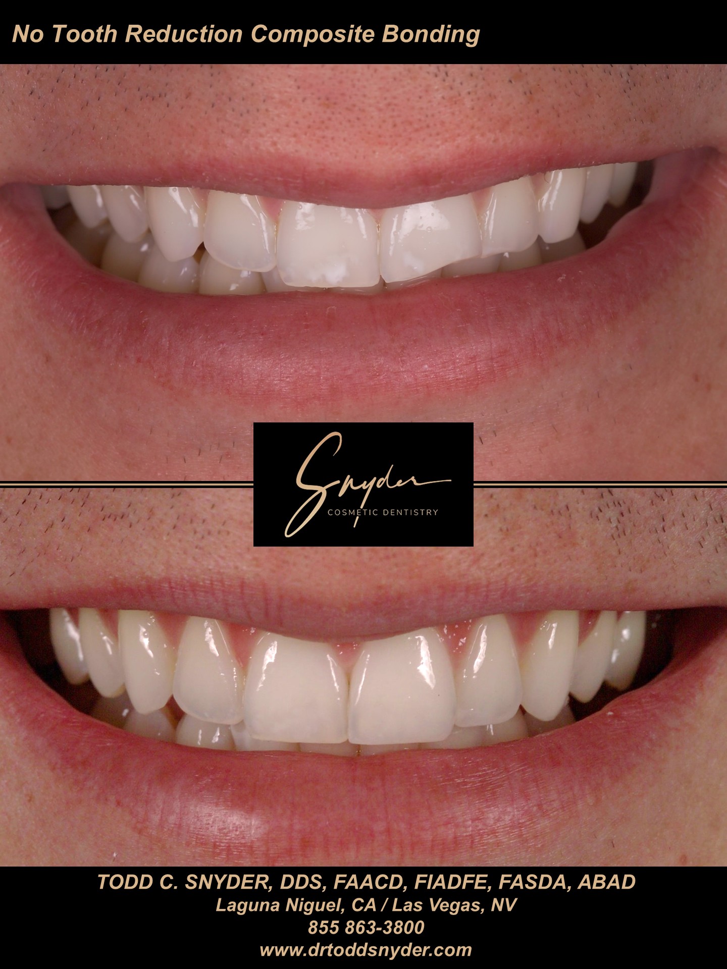 No tooth reduction composite bonding, before and after