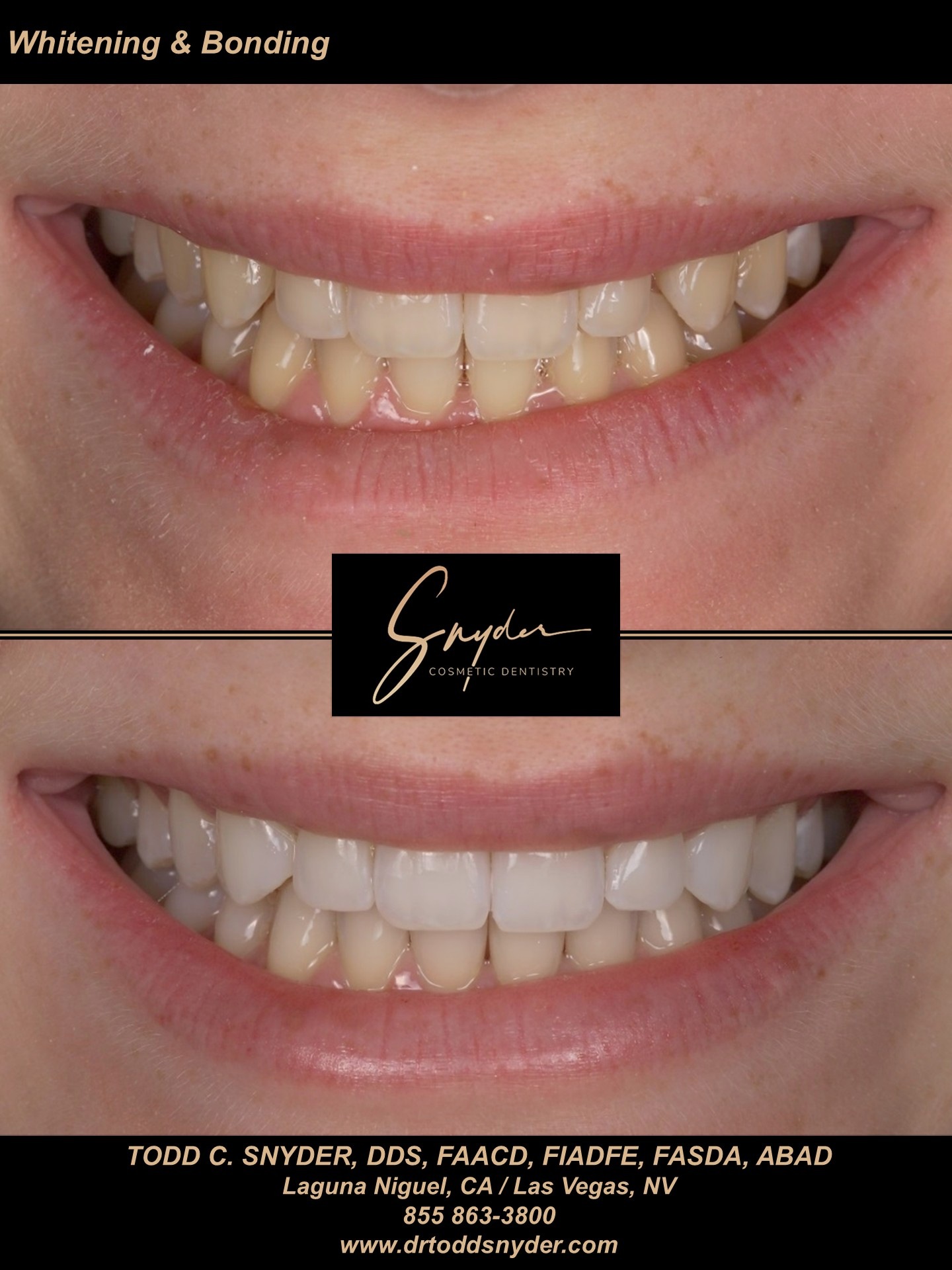 Whitening and bonding, before and after