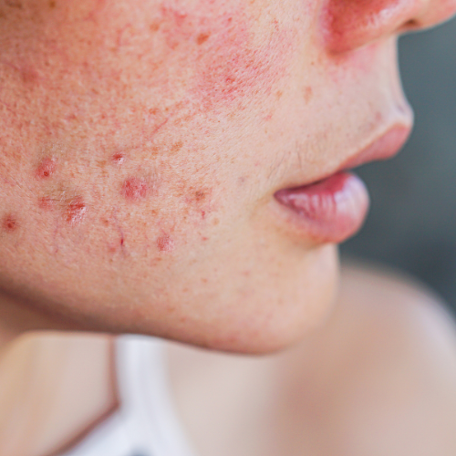 Young blond woman with face acne possibly that can indicate hormonal imbalances
