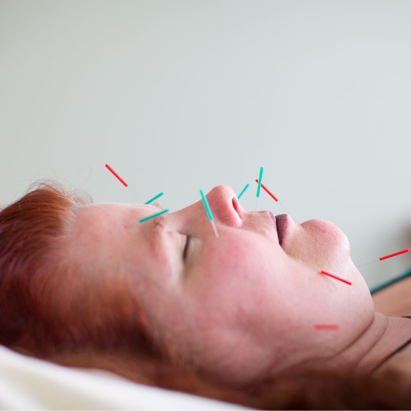 Facial Acupuncture-1