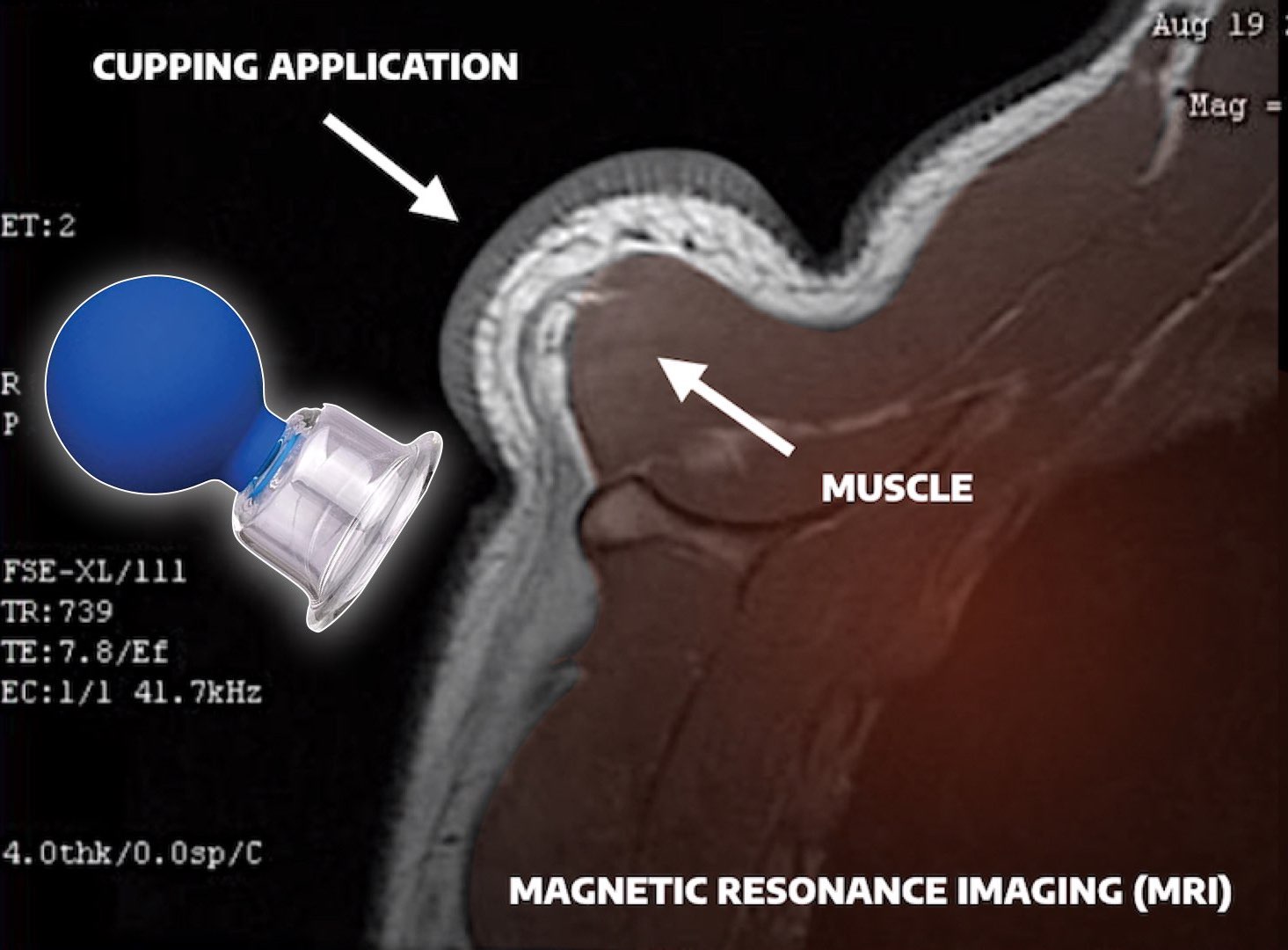 MyoFascial Cupping MRI