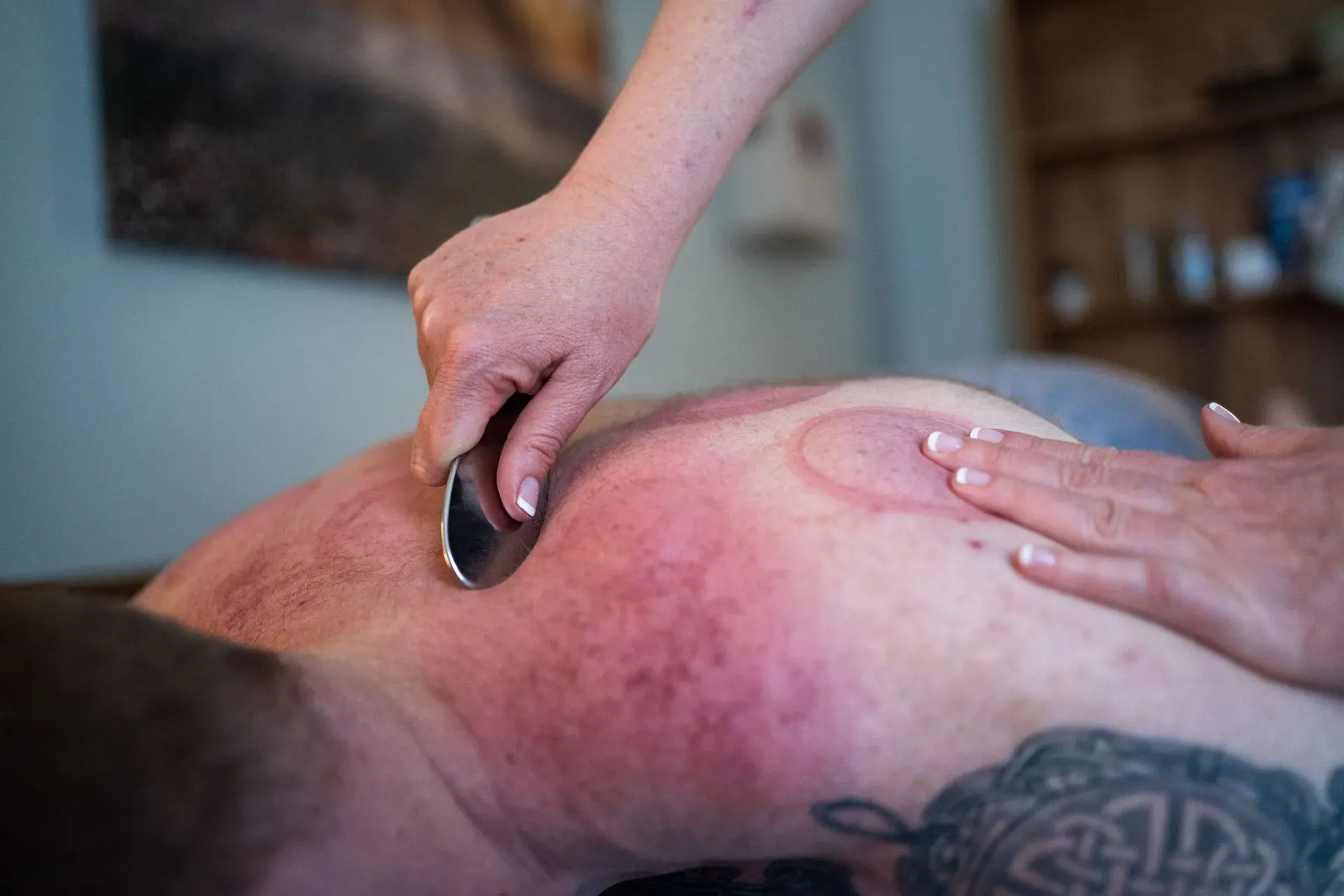 Experience Cupping Therapy, Gua Sha, & Moxa at Carolina Family Acupuncture