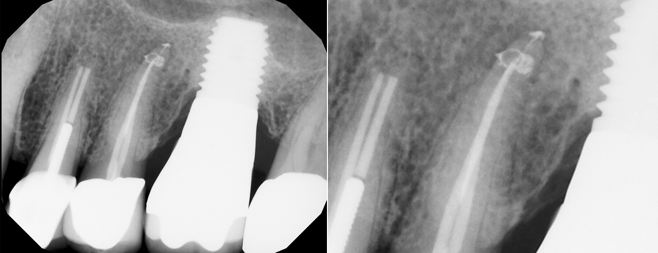 Teach Me to Be a Laser Dentist - A Crash Course on Diode Lasers and Restorative Dentistry With Dr Ron Kaminer-Live Demonstration Webinar