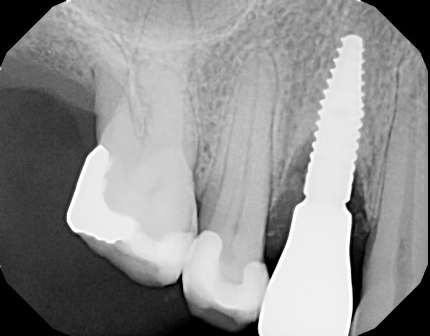 Zeeba Education Biologic Implant Complications