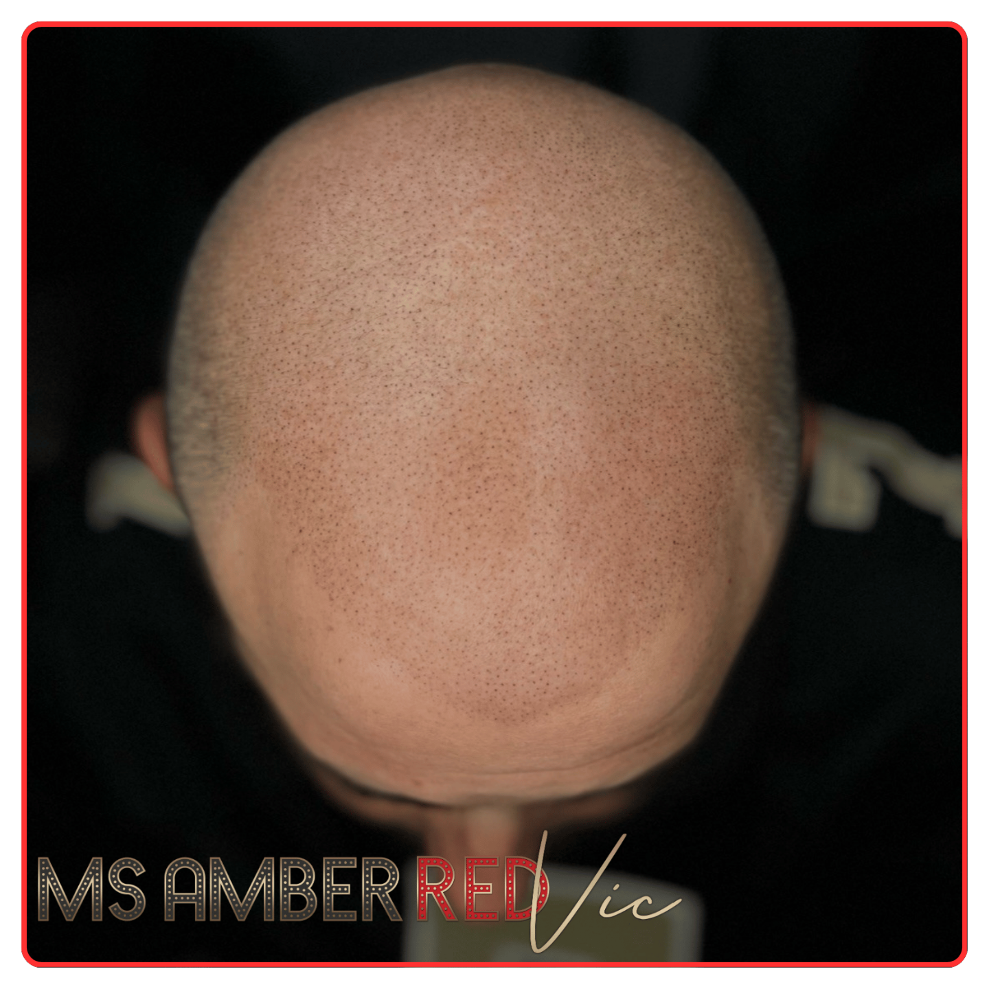 Scalp Micropigmentation to help with hair loss in Las Vegas Nevada