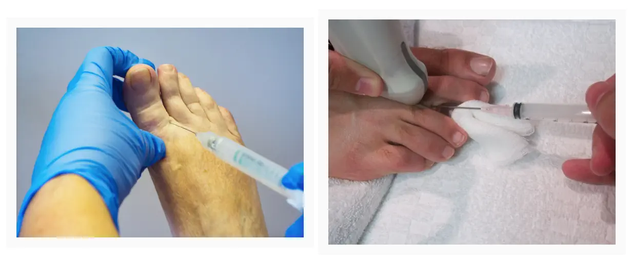 Clinician performing ultrasound guided injection therapy in between the toes