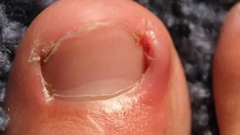 Close-up of a big toe showing an ingrown toenail with redness and swelling along the nail edge