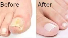 Fungal nail before and after treatment