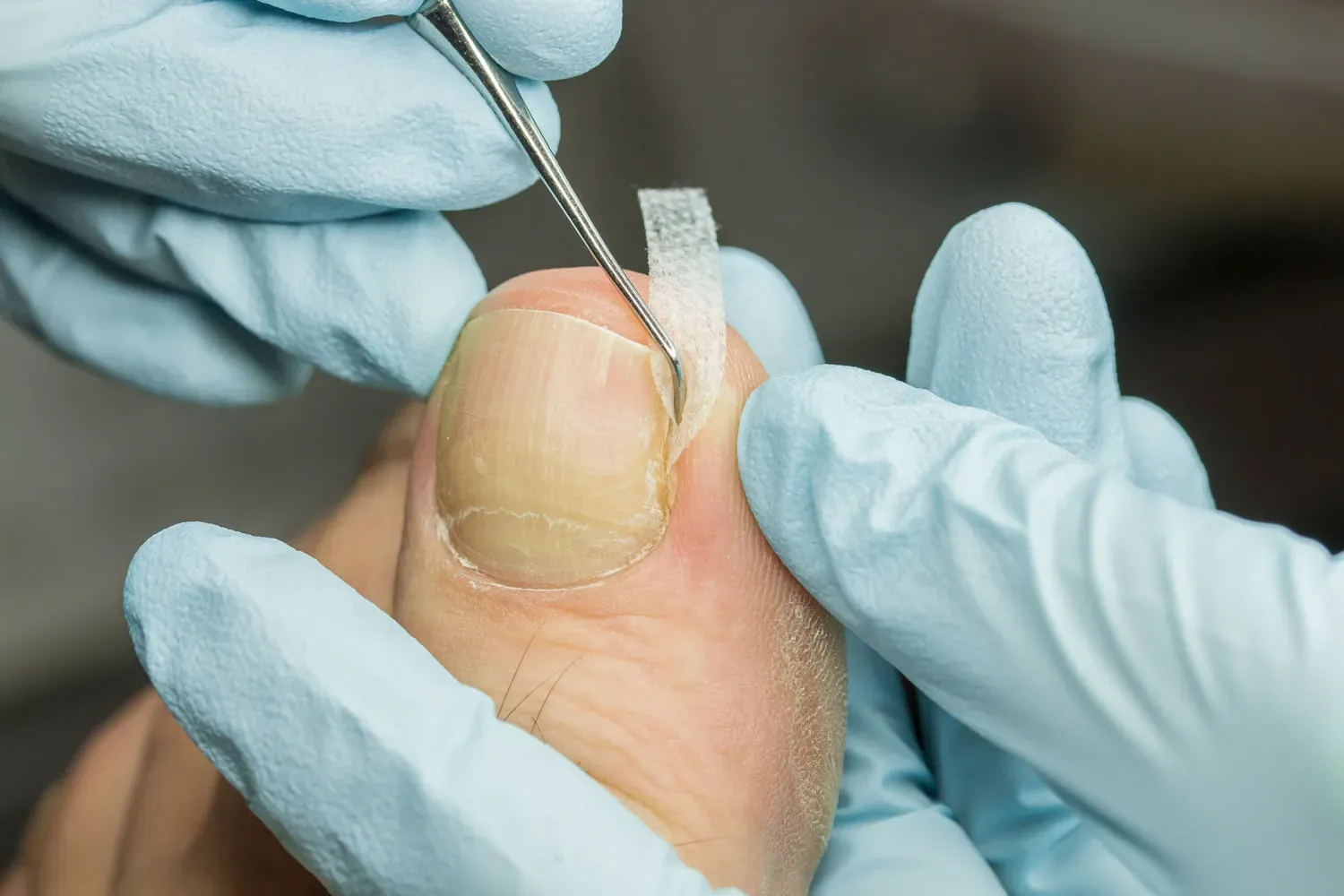 Ingrown Toenails