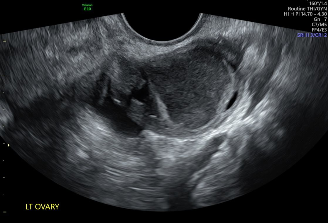 Ovary Endometriosis