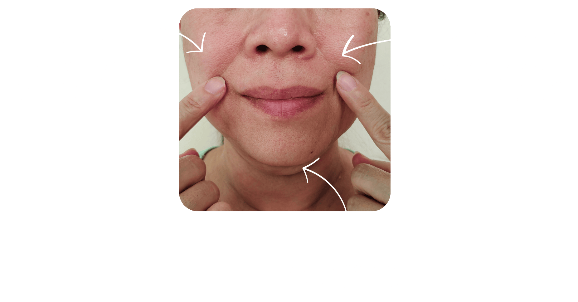 image of woman showing her facial folds, sagging cheeks, and jowls