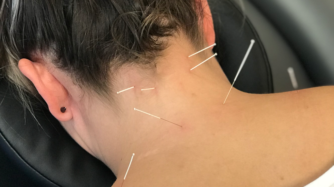 Image of dry needling technique targeting trigger points for muscle pain relief with a sports chiropractor in Westminster CO.