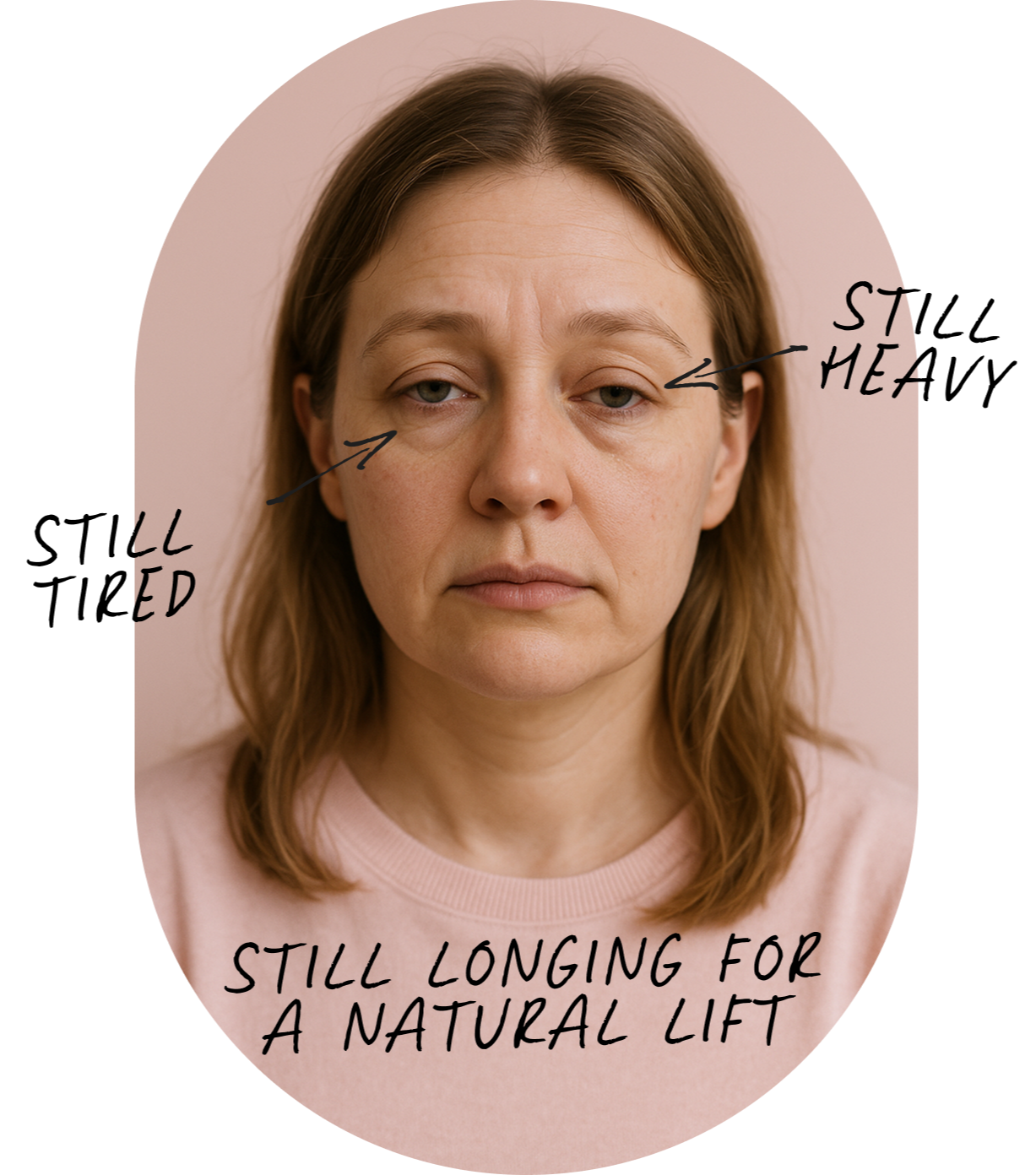 before and after results of Face Lift with Valeriia