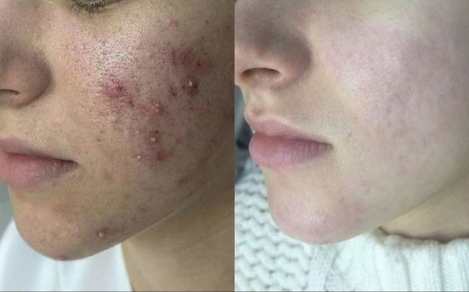 Clear Skin Decoder guide preview