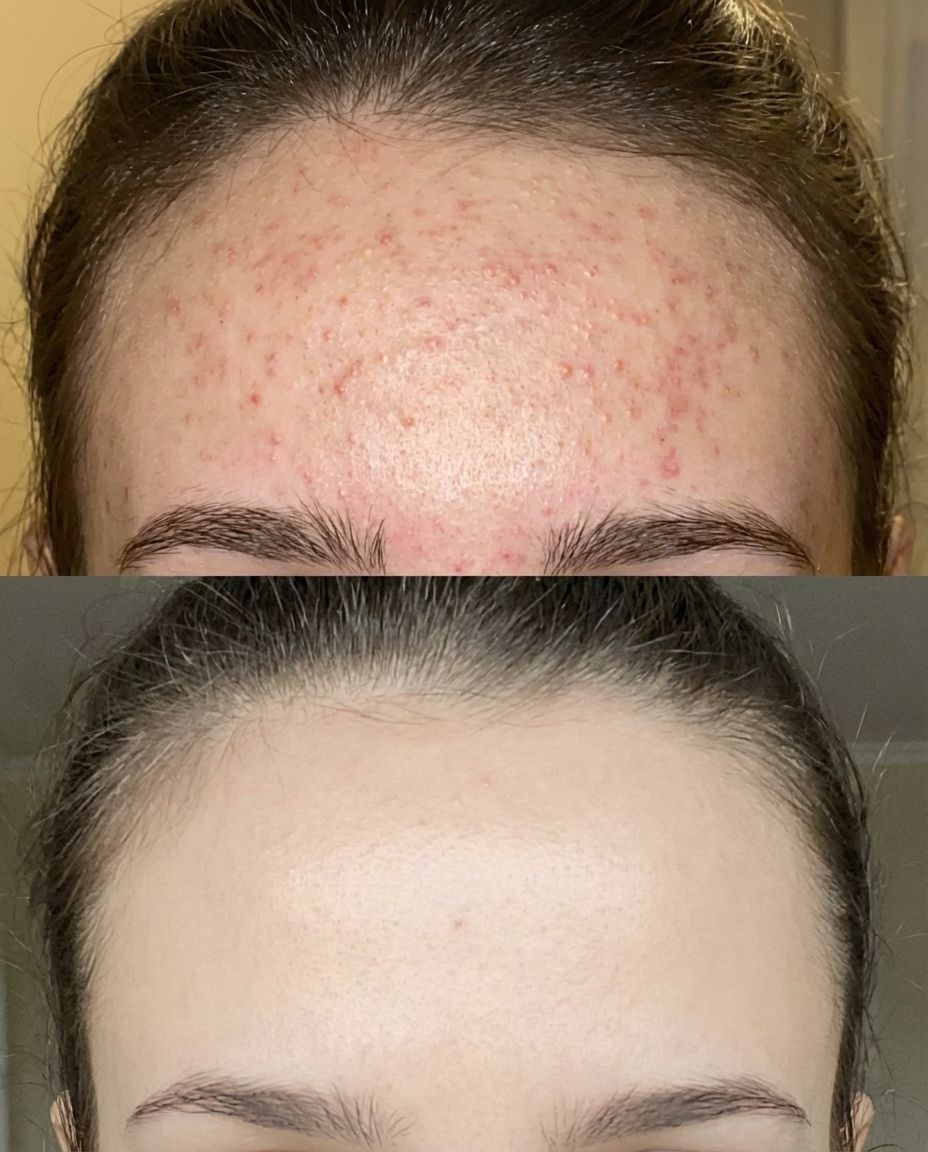Acne-prone woman