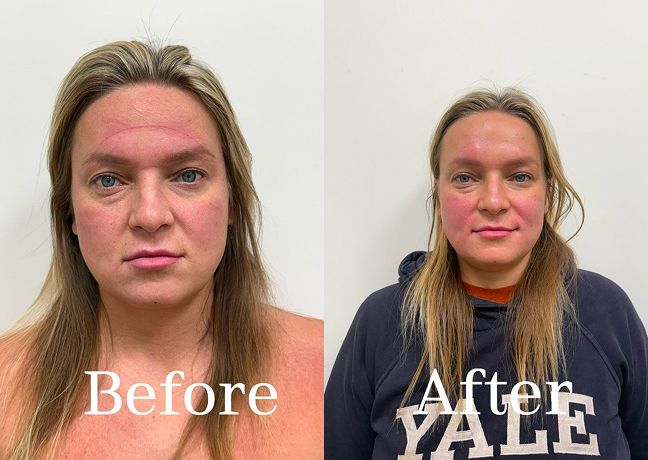 Before and after comparison: on the left, there is noticeable morning puffiness; on the right, the face looks fresher, less swollen, and naturally lifted.