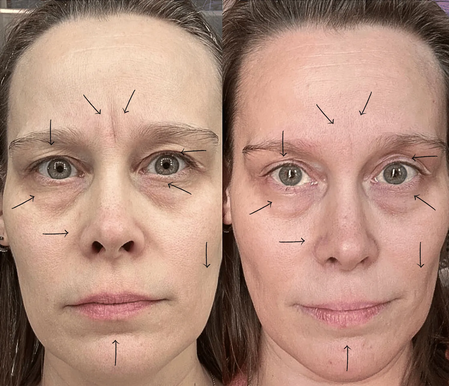 Amanda's 11 line disappeared, undereyes brightened, nasolabial folds lessened, and hooded eyes lifted in 14 days