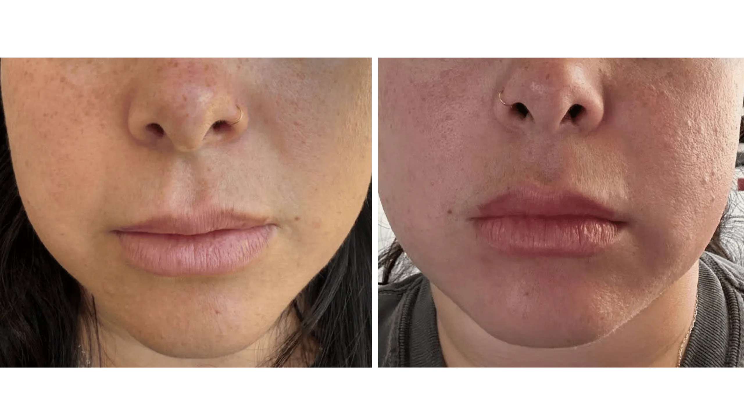 Before and after photo of Beth with crooked and then symmetrical lips