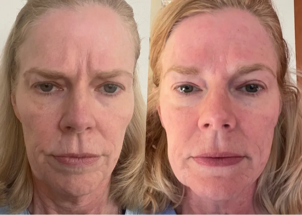 Before after pics of Stephanie's smoothed and lifted face