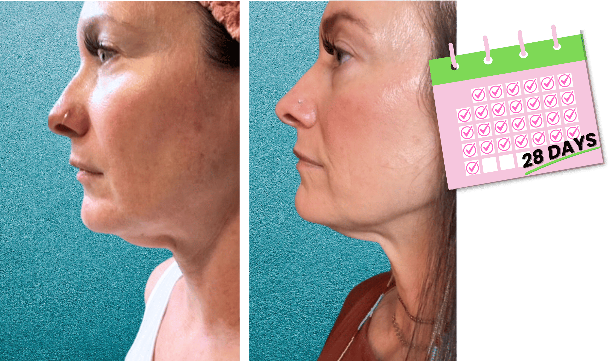 Jennifer's before and after pics with erased crow's feet, lifted brows, and firmer neck