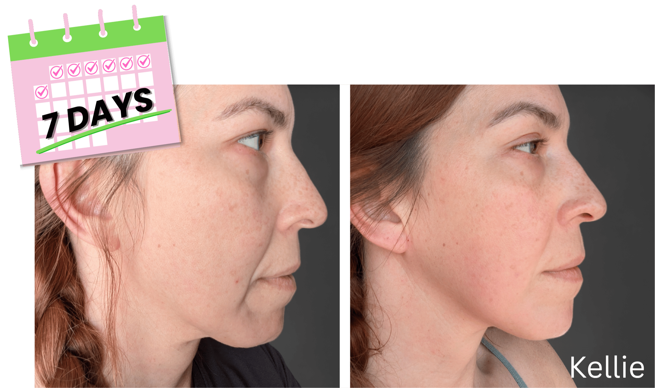 Kellie's before and after pics with lifted nasolabial folds and eyelids