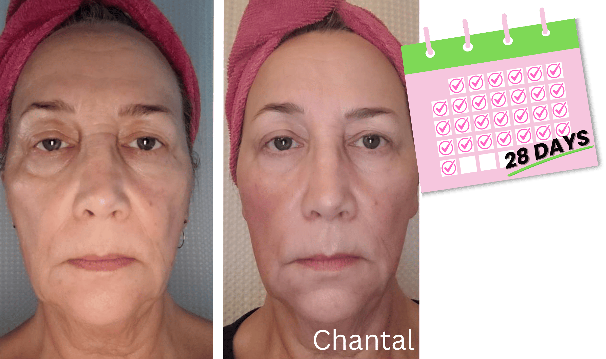 Chantal's before and after pics with a full face rejuvenation