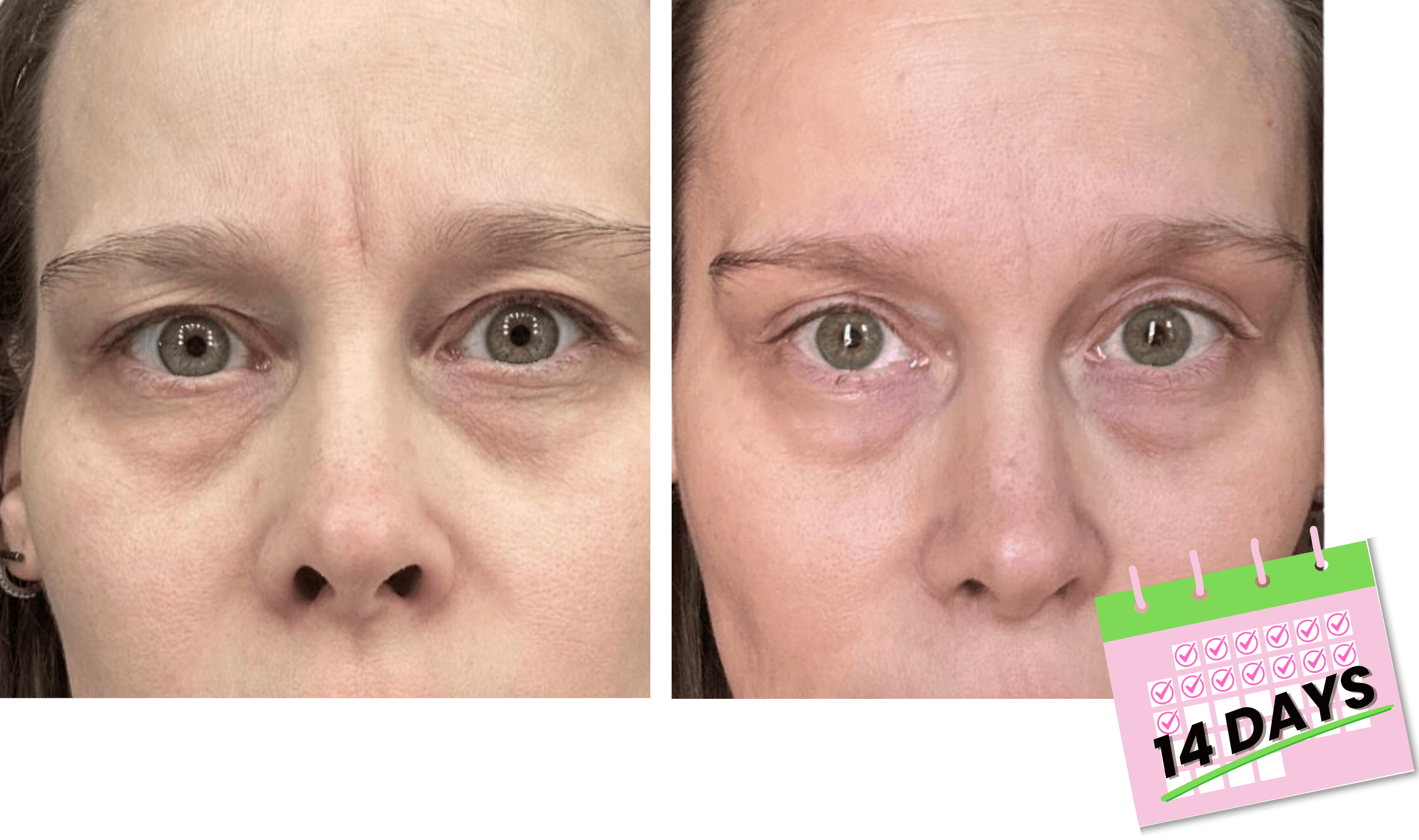 Amanda's before and after pics with smoothed 11 lines