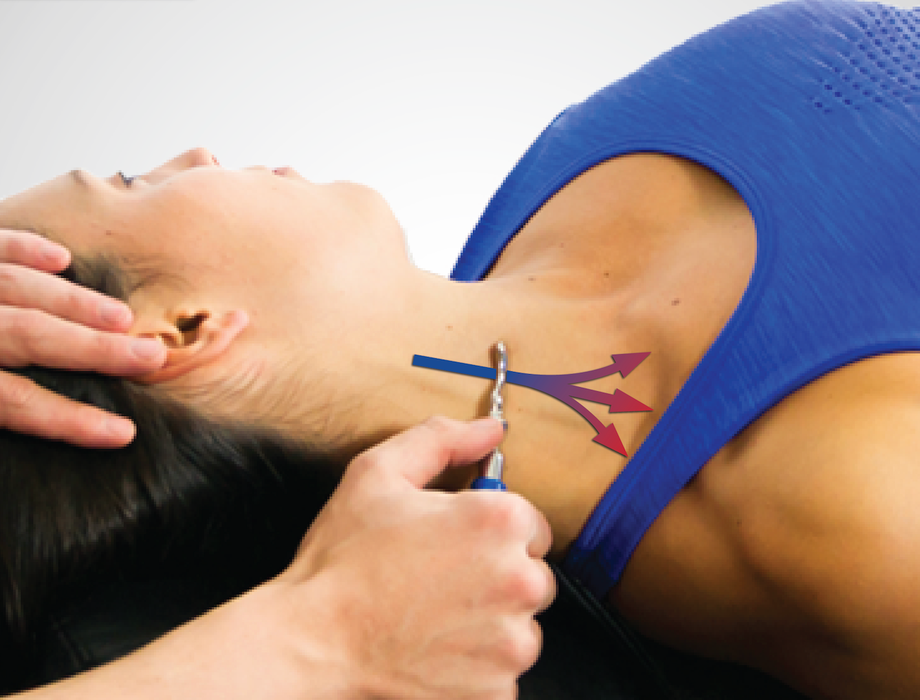 Small IASTM tool working on the Scalenes of the neck.