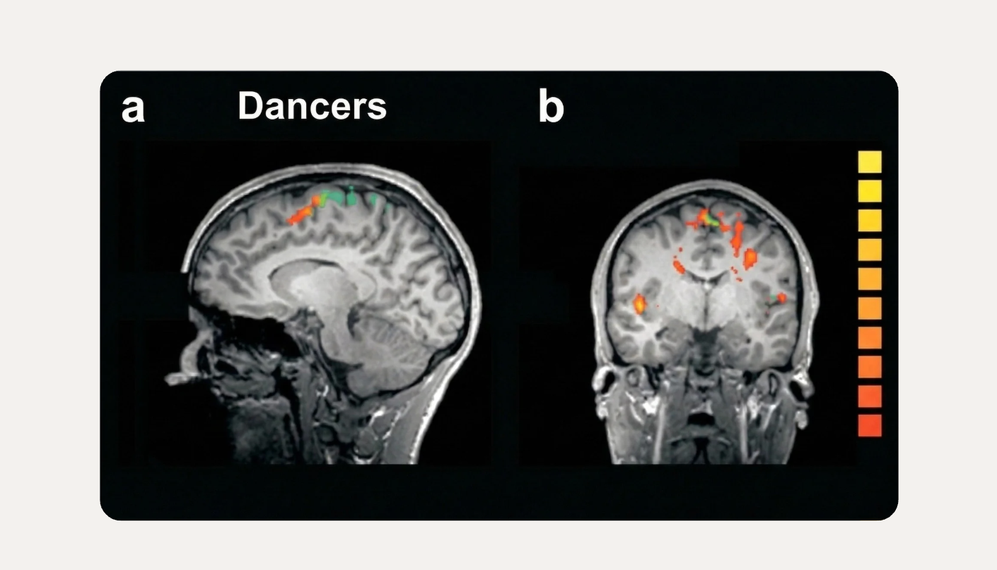 Dancer brain mri image 