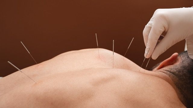 Acupuncture on the neck and shoulder, providing temporary relief but not fixing TOS weakness