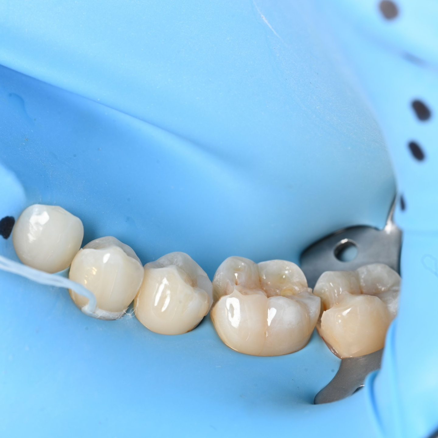 Clinical adhesive dentistry — composite restoration technique
