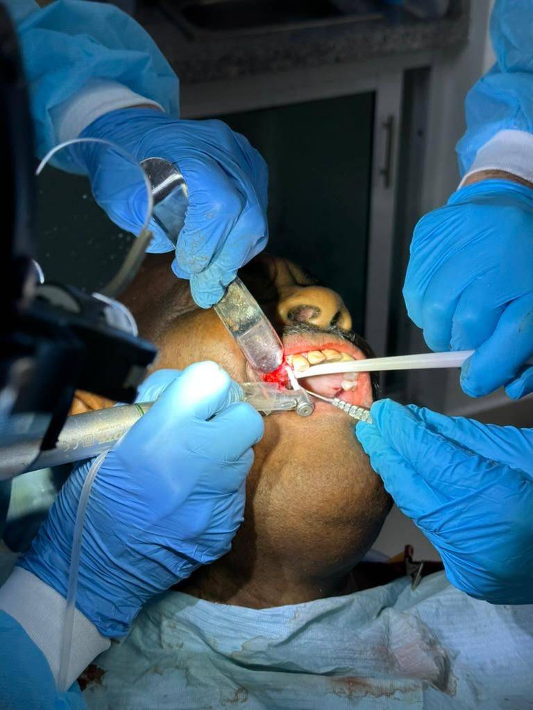 Multi-implant full-arch case