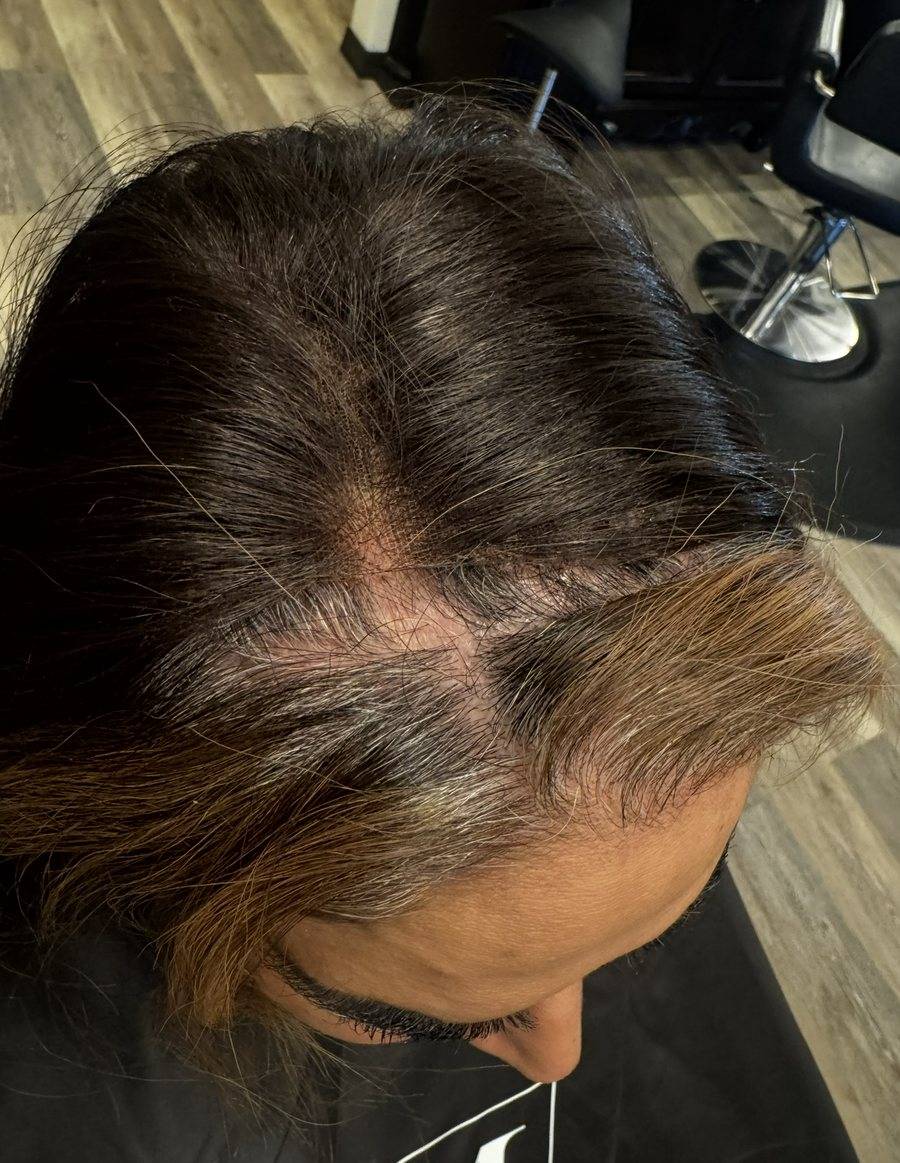 Scalp showing through at the hairline