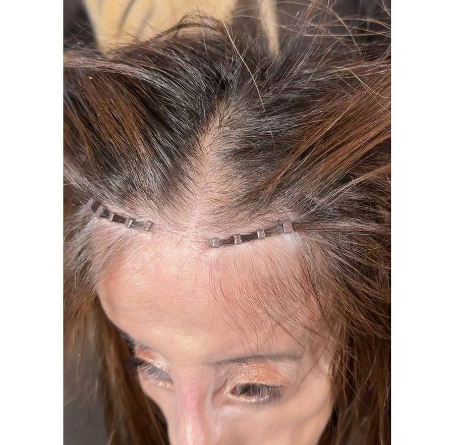 Mesh integration at the hairline