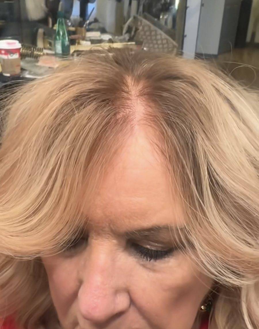 Hairline with a system on
