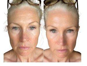 Before and after face yoga results