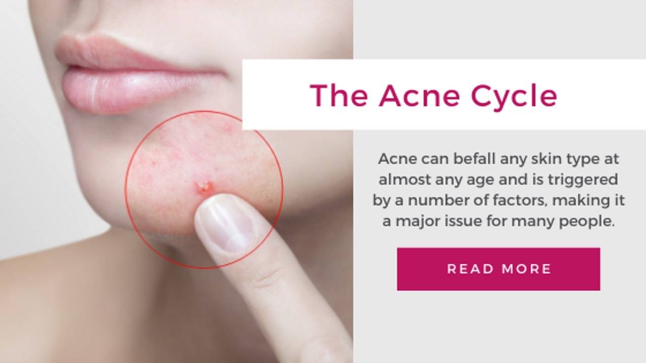 The Acne Cycle
