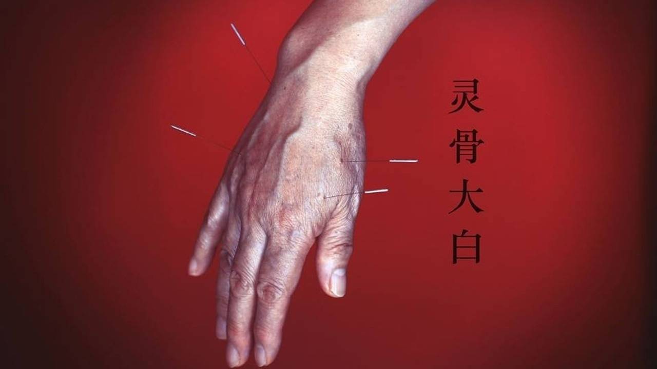 How Does an Acupuncturist Choose Which Points To Needle
