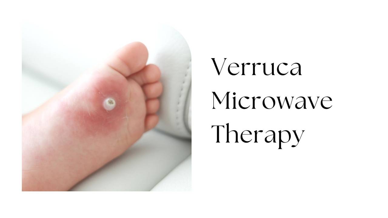 Verruca What are they and how can they be treated?
