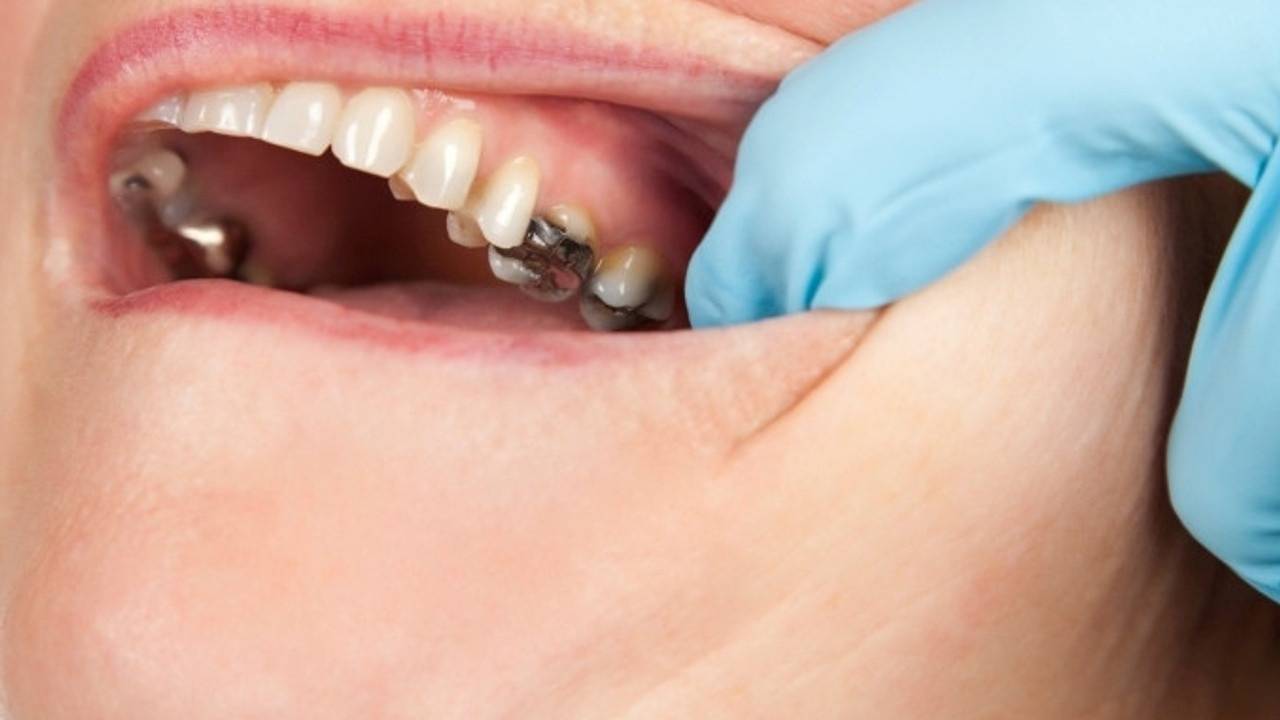 Metal Fillings Can Cause