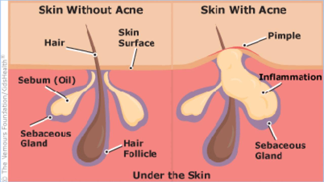 does glutathione cause breakouts Acne