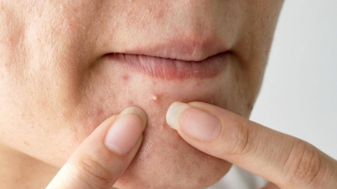 Menopausal Acne