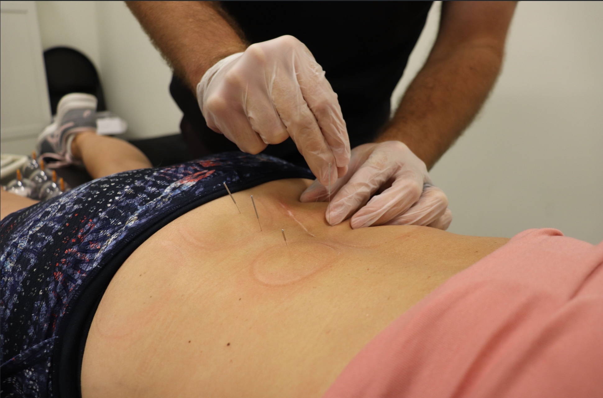 dry needling for back beachwood ohio