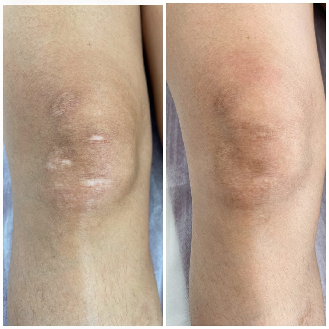 Surgical scar camouflage — healed result
