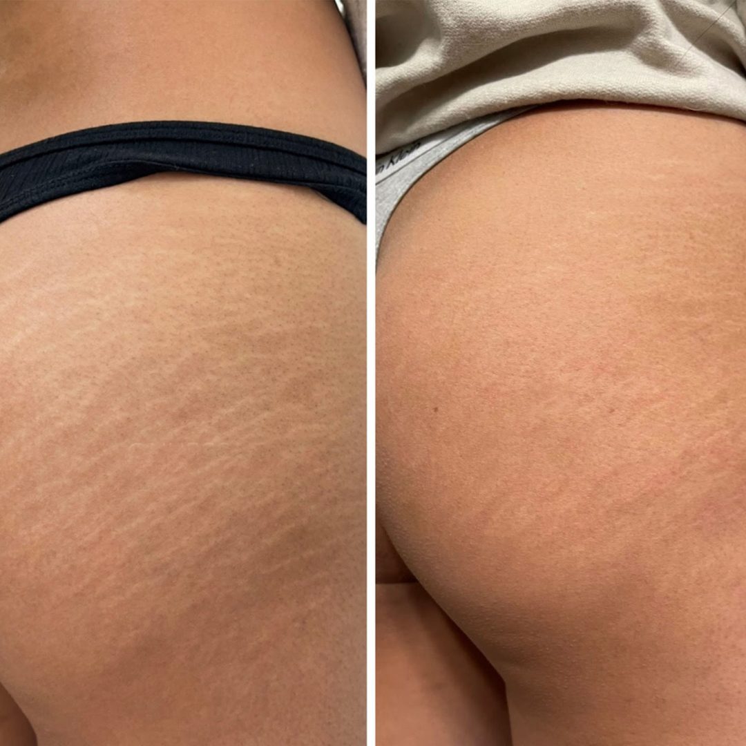 Postpartum stretch mark revision